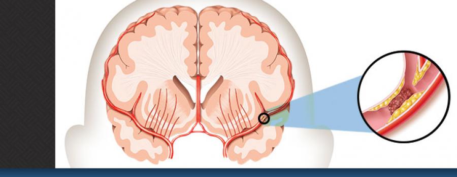 کمک های اولیه هنگام حمله یا سکته مغزی