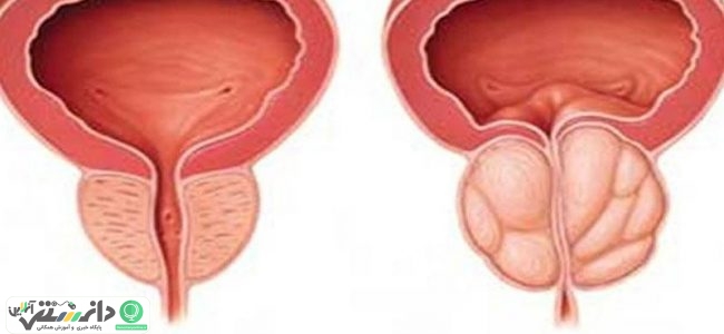 راهنمای آموزش بیماران بزرگی خوش خیم پروستات + ویدئو