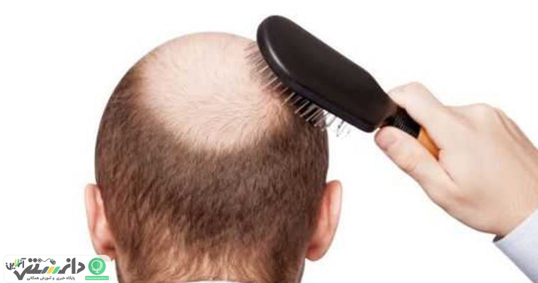 علت ریزش مو چیست؟