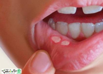«آفت دهان» و پاسخ سؤالات در رابطه با آن
