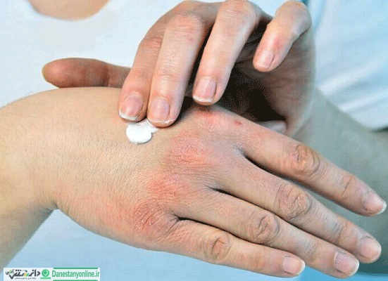 خشکی پوست دست خود را چطور در خانه درمان کنیم؟