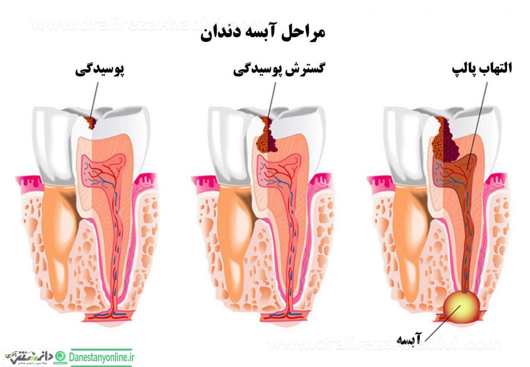 دانستنی های دندانپزشکی/آبسه دندان