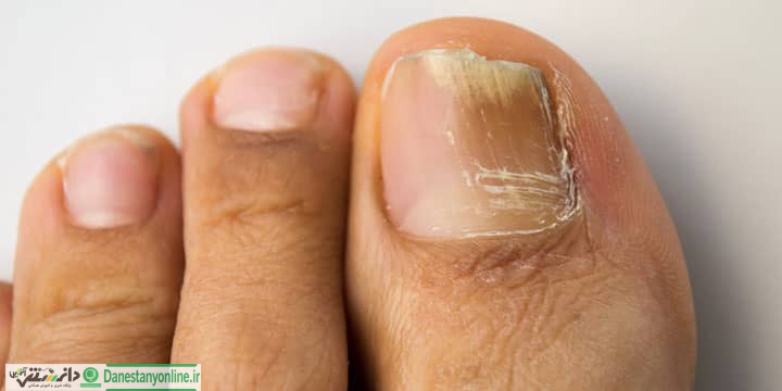 ظاهر ناخنها خبر از چه بیماریهایی میدهند؟