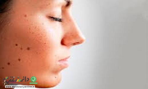 دلایل ایجاد خال بر روی پوست