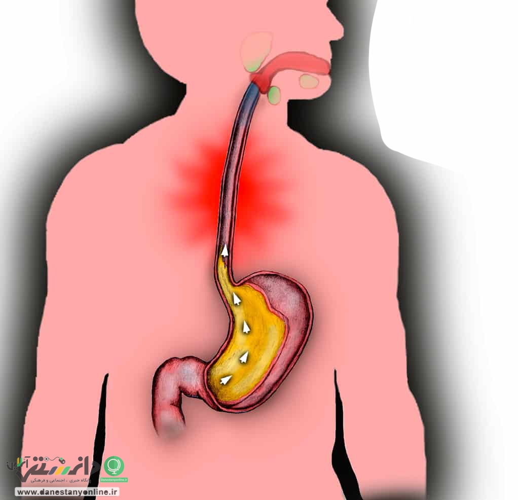 رفلاکس معده