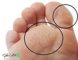 زخم پای دیابتی