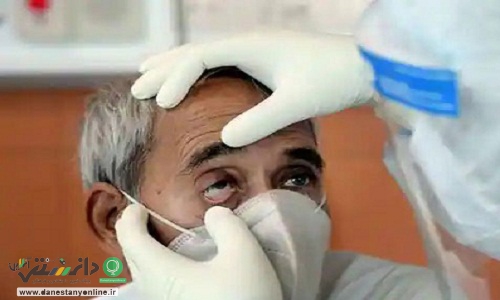 قارچ سیاه از پیامدهای کرونا در برخی افراد