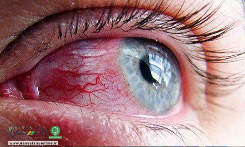 تشخیص علائم کرونای طولانیمدت از طریق چشم