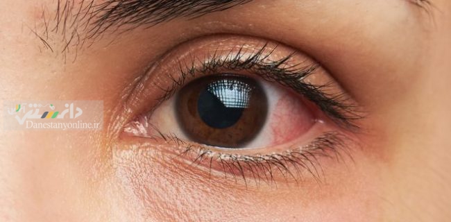 از تیروئید چشمی چه می دانید؟