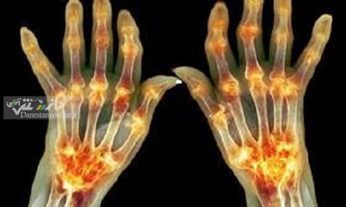 ۴۰ درصد مبتلایان به کرونا دردهای عضلانی و مفاصل را تجربه میکنند
