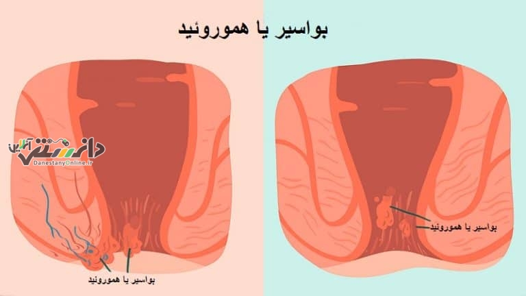 دانستنی سلامت/علائم و درمان هموروئید یا بواسیر