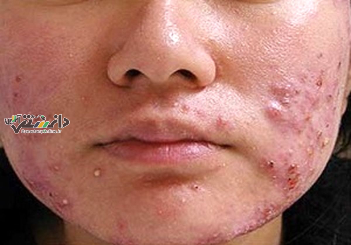 راهکارهای خانگی برای از بین بردن جای جوش