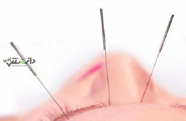 تاثیر طب سوزنی بر کاهش سردردهای تنشی
