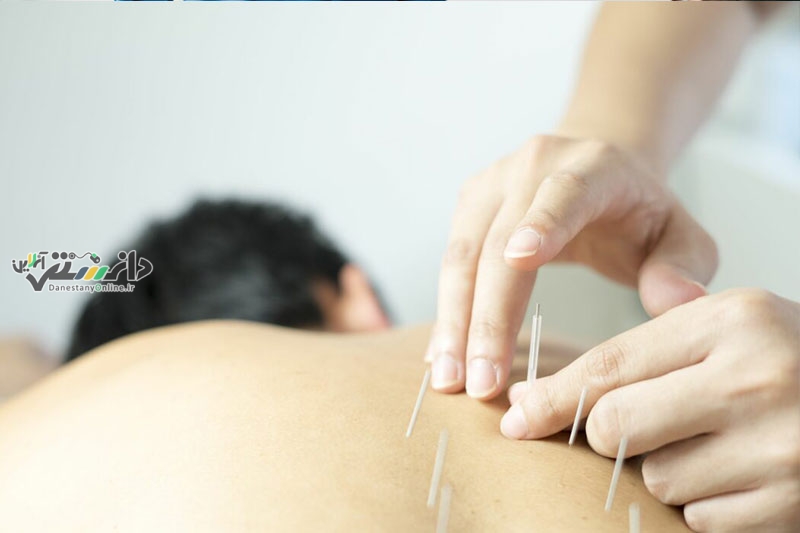 تاثیر طب سوزنی بر کاهش سردردهای تنشی