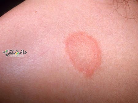 مصرف سدیم با خطر ابتلا به بیماری پوستی مزمن