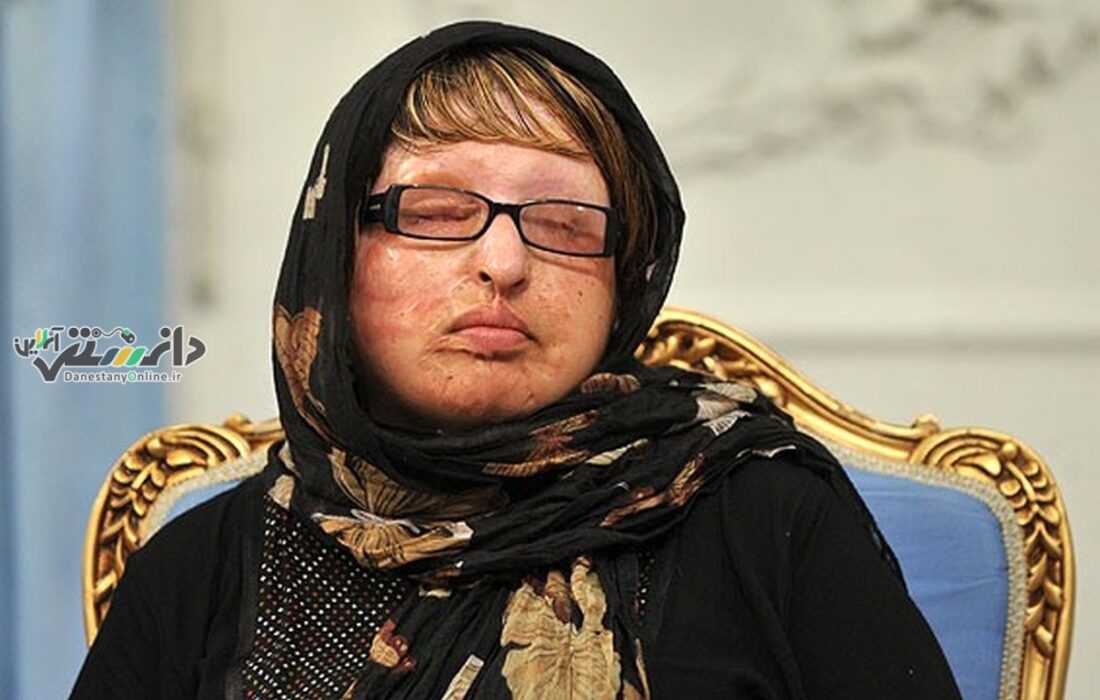 قربانی اسیدپاشی در جستجوی عدالت!