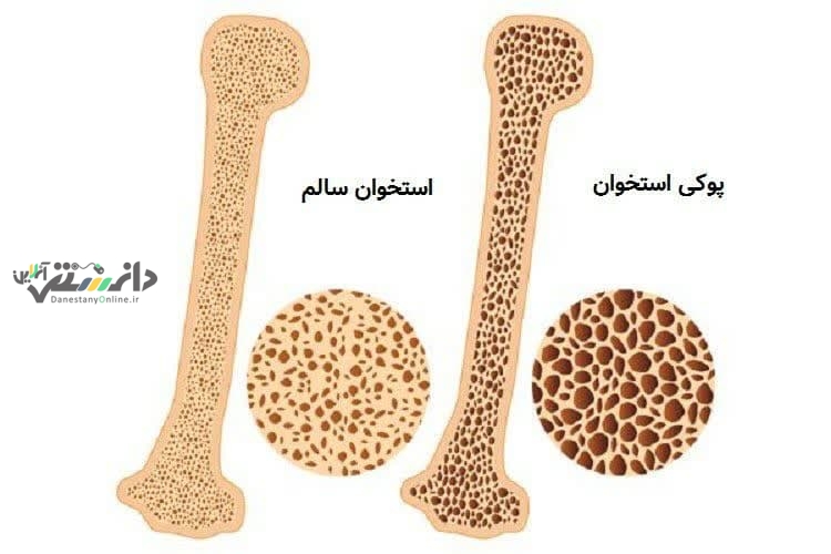 علت بروز پوکی استخوان