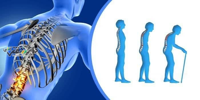دانستنی پزشکی/بیماری پوکی استخوان و علائم آن