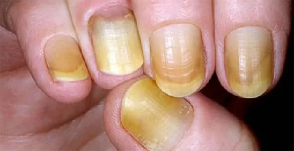 سندرم ناخن زرد