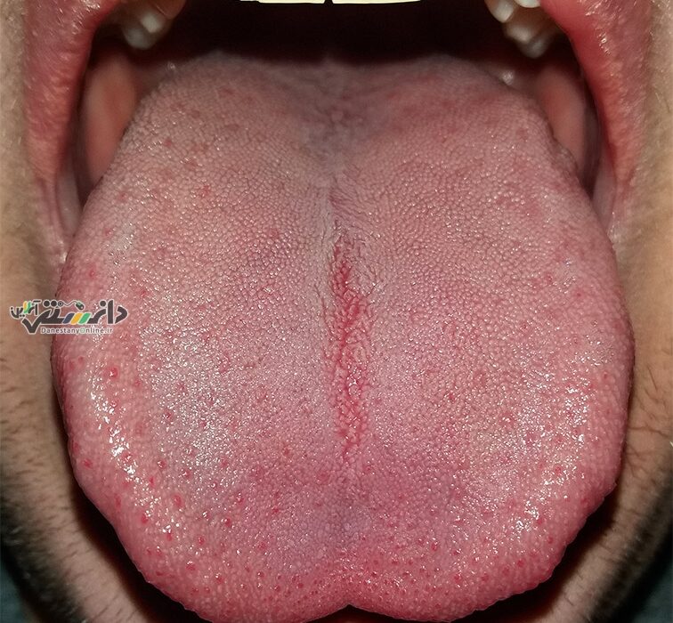 تشخیص بیماریها از طریق رنگ زبان
