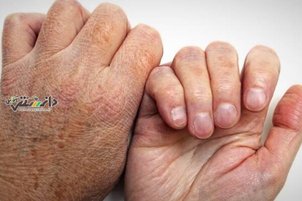 اخبار شیوع جذام در کشور شایعه است