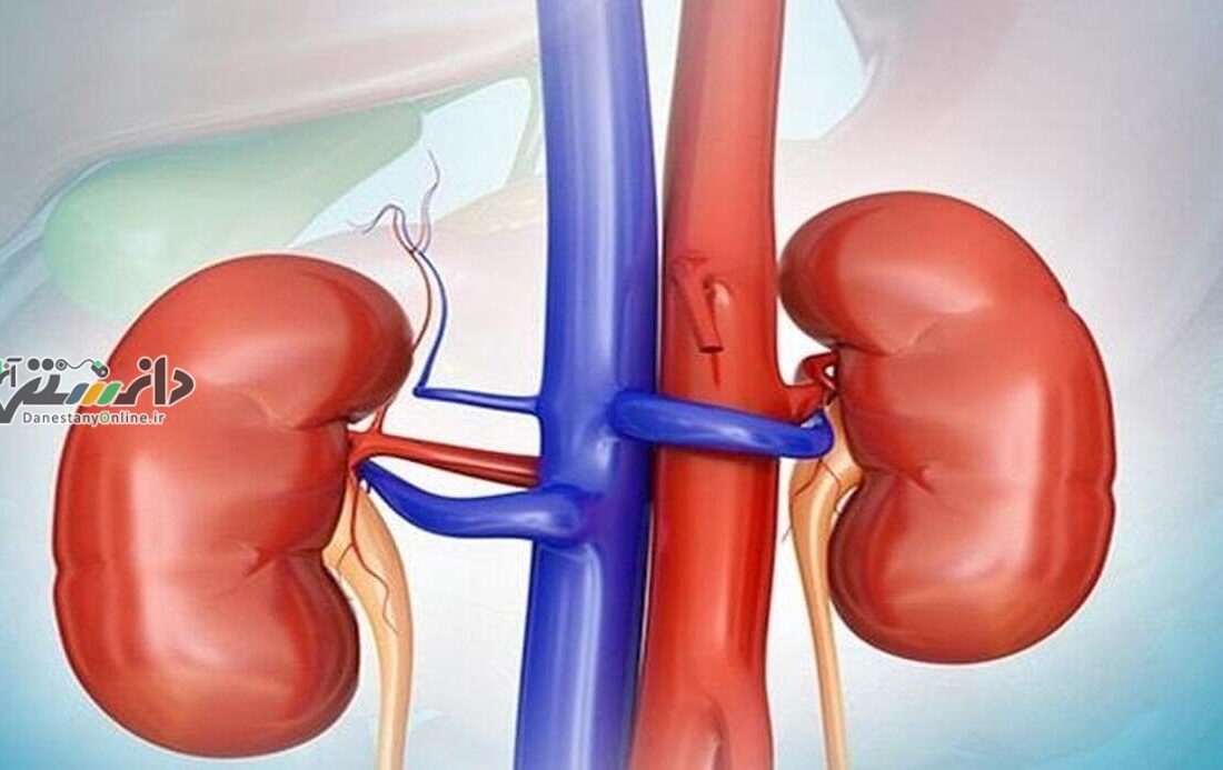 ۴ نوشیدنی معجزهگر برای درمان سنگ کلیه