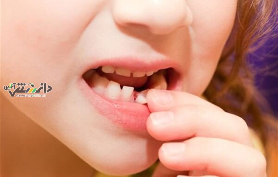 اهمیت دندان شیری و تاثیر آنها روی دندان های دائمی