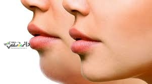 لیفت غبغب در خانه