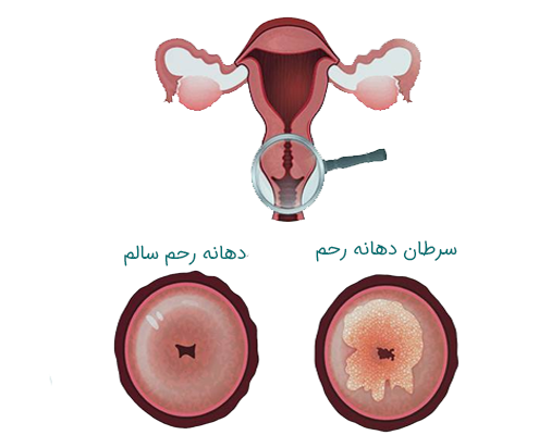 علائم سرطان دهانه رحم