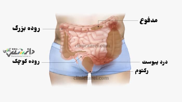 دانستنی سلامت/گیاه معجزه گر برای درمان یبوست