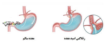 دانستنی پزشکی/درمان رفلاکس معده با روزه داری