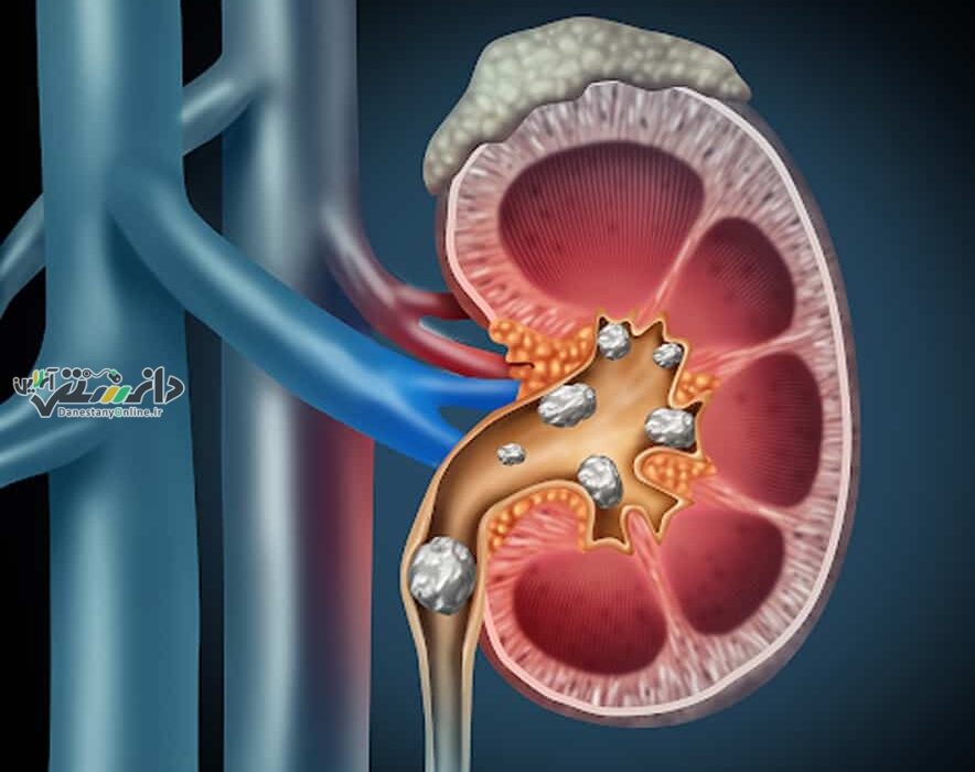 دانستنی علمی پزشکی/تغذیه مناسب برای حفظ سلامت کلیهها