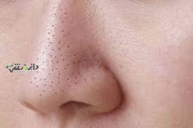 دانستنی سلامت/از بین جوش سرسیاه بینی با یک روش ساده
