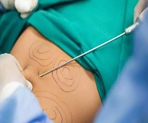 دانستنی تناسب اندام/آیا لیپوساکشن شما را خوش اندام می کند؟!