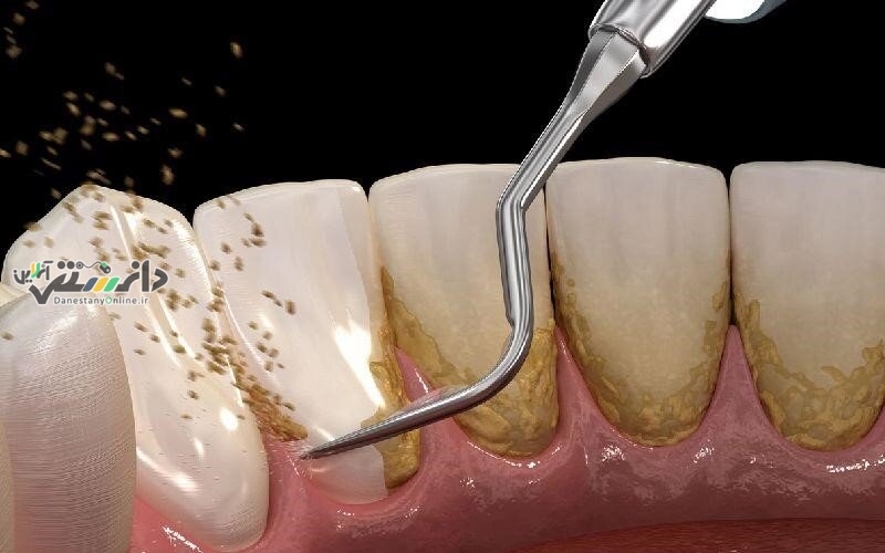 دانستنی سلامتی/جرم گیری باعث از بین رفتن مینای دندان میشود ؟