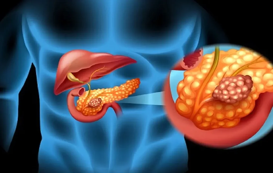 دانستنی سلامتی/روش های خانگی و گیاهی سم زدایی پانکراس