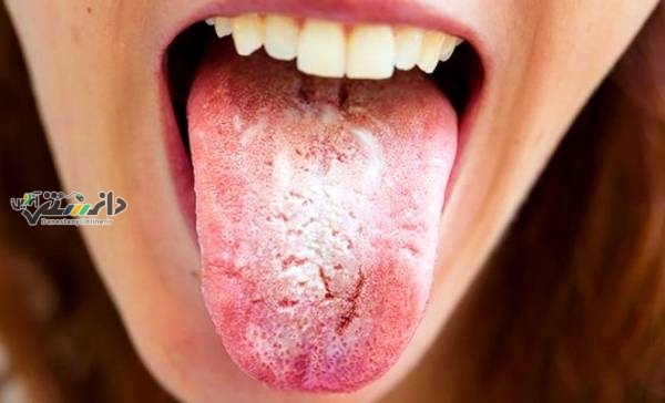 دانستنی سلامتی/چرا دهان دیابتی ها خشک می شه؟