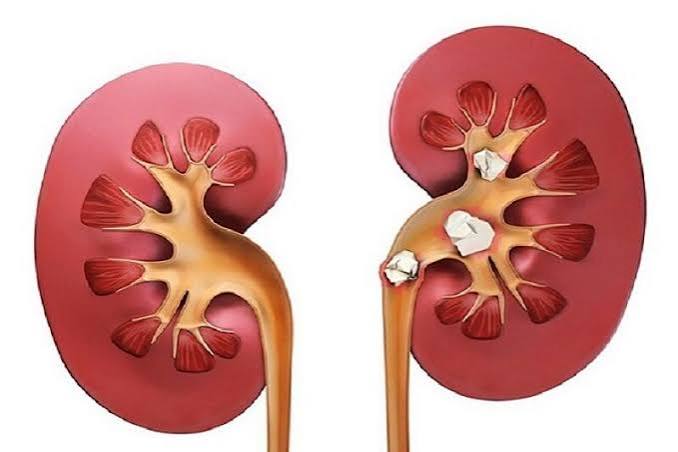 ماءالشعیر واقعاً برای کلیه خوب است یا بد؟