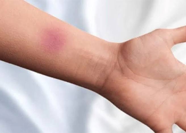 یکی از دلایل کبودیِ بیدلیل پوست